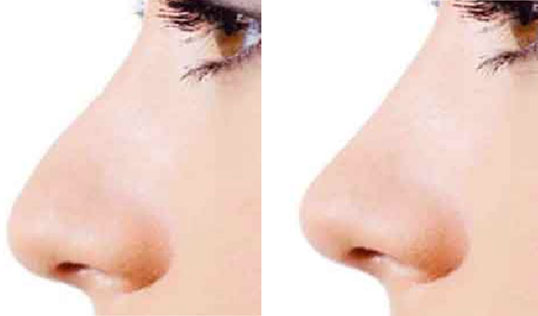 Non-Surgical Nose Lift