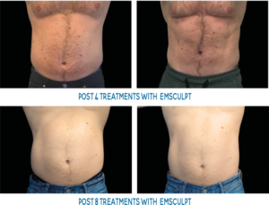 CoolSculpting Fat Reduction – Cascade Eye & Skin Centers