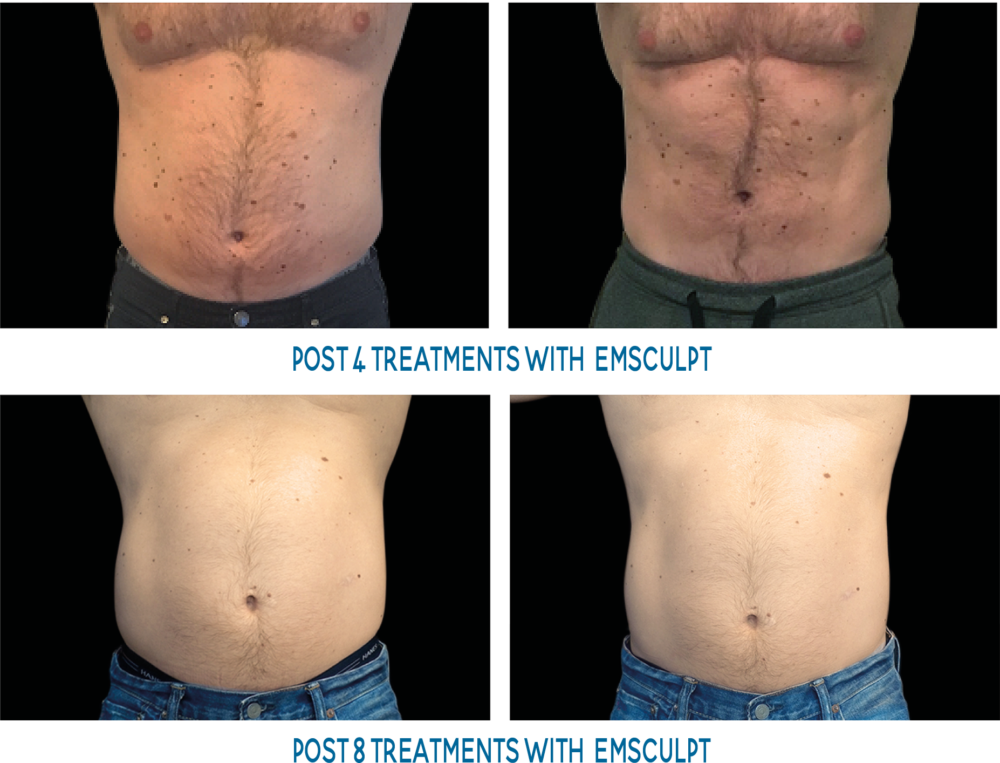 Male abs before and after emsculpt InnerImage
